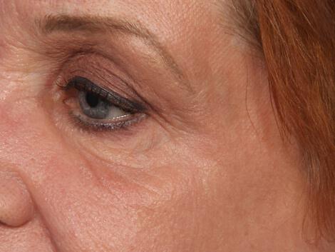 Laser Skin Resurfacing Gallery Before & After Image