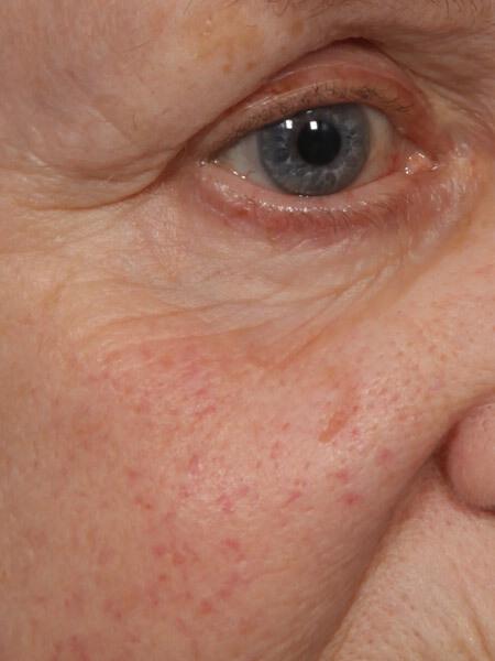 Laser Skin Resurfacing Gallery Before & After Image