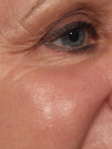 Laser Skin Resurfacing Gallery Before & After Image