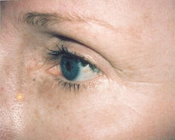 Laser Skin Resurfacing Gallery Before & After Image