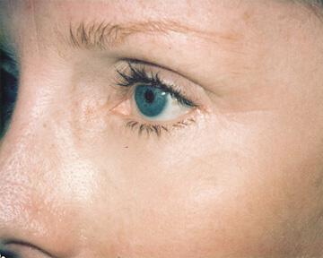 Laser Skin Resurfacing Gallery Before & After Image