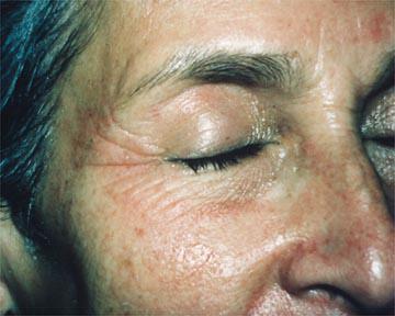 Laser Skin Resurfacing Gallery Before & After Image