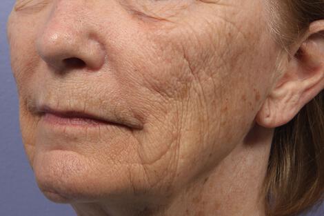 Laser Skin Resurfacing Gallery Before & After Image