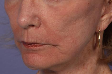 Laser Skin Resurfacing Gallery Before & After Image