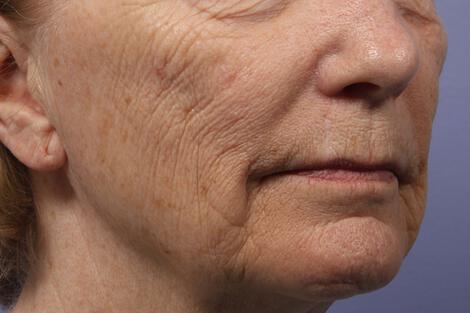 Laser Skin Resurfacing Gallery Before & After Image