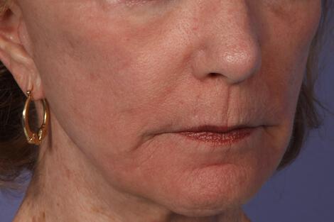 Laser Skin Resurfacing Gallery Before & After Image