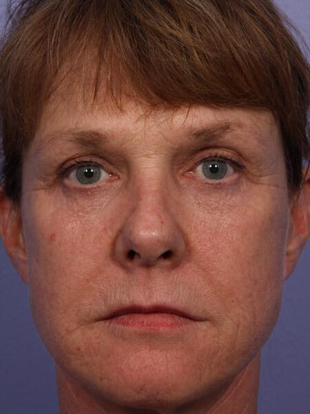 Laser Skin Resurfacing Gallery Before & After Image