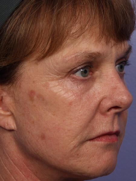 Laser Skin Resurfacing Gallery Before & After Image