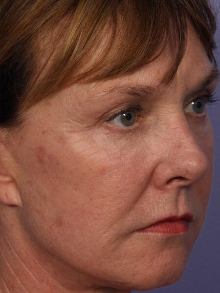 Laser Skin Resurfacing Gallery Before & After Image