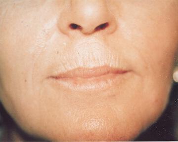 Laser Skin Resurfacing Gallery Before & After Image