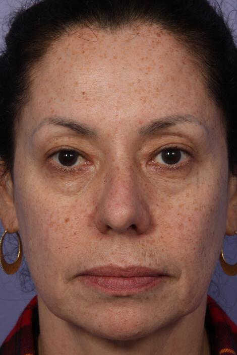 Laser Skin Resurfacing Gallery Before & After Image