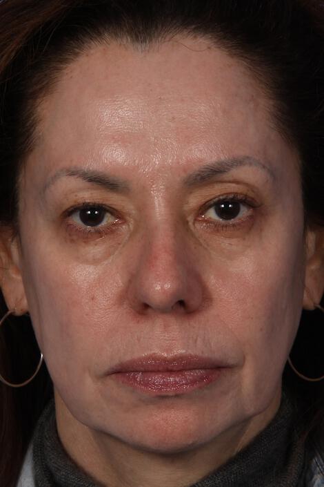 Laser Skin Resurfacing Gallery Before & After Image