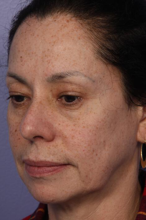 Laser Skin Resurfacing Gallery Before & After Image