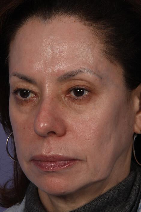 Laser Skin Resurfacing Gallery Before & After Image