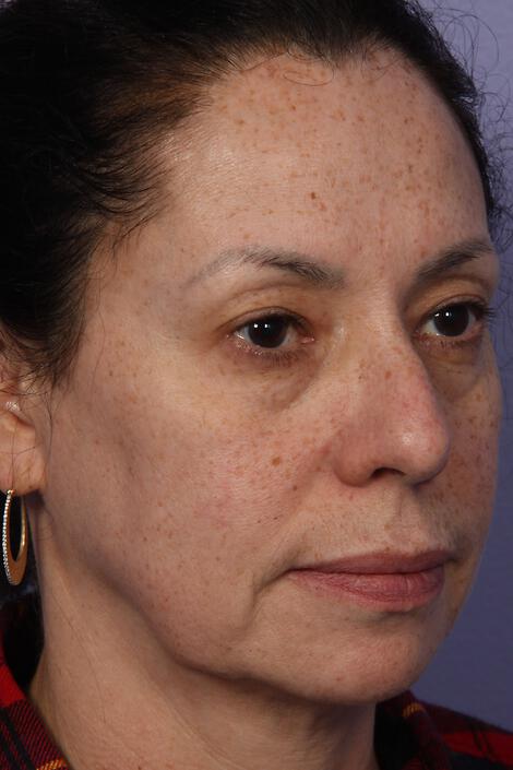 Laser Skin Resurfacing Gallery Before & After Image