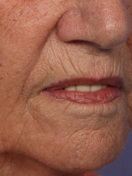 Laser Skin Resurfacing Gallery Before & After Image