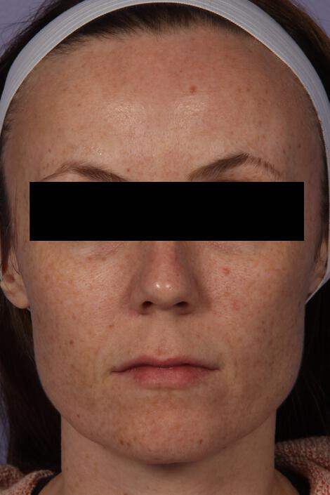 Laser Skin Resurfacing Gallery Before & After Image