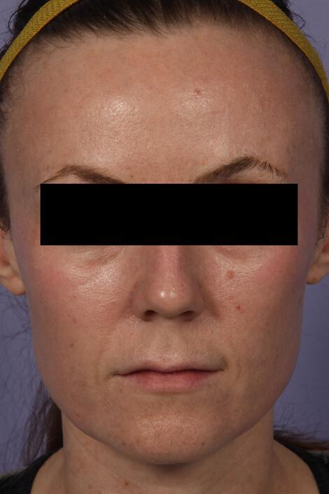 Laser Skin Resurfacing Gallery Before & After Image