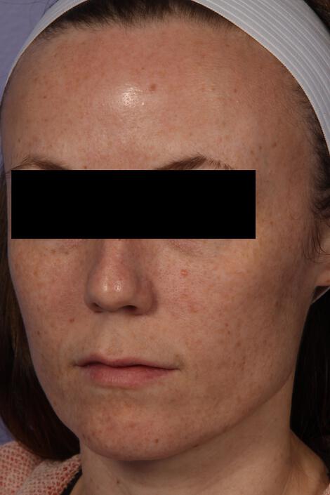 Laser Skin Resurfacing Gallery Before & After Image