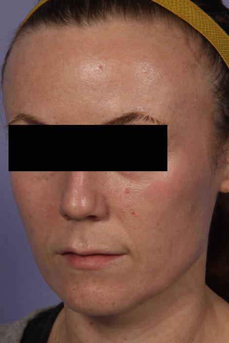 Laser Skin Resurfacing Gallery Before & After Image