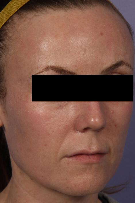 Laser Skin Resurfacing Gallery Before & After Image