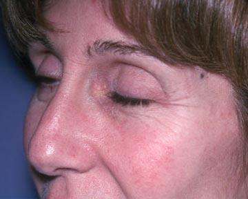 Laser Skin Resurfacing Gallery Before & After Image