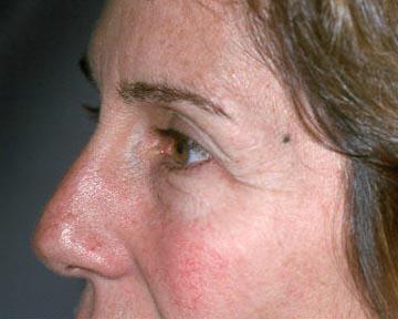 Laser Skin Resurfacing Gallery Before & After Image