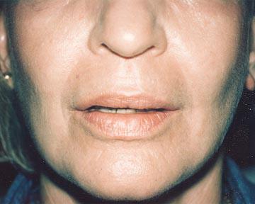 Laser Skin Resurfacing Gallery Before & After Image