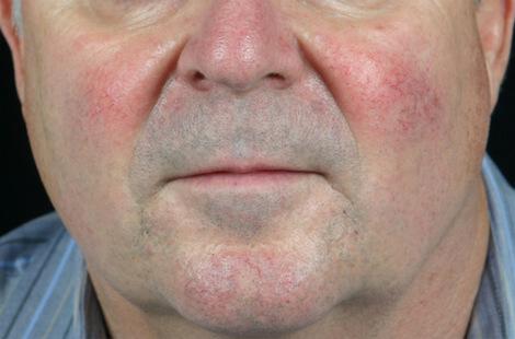 Laser Skin Resurfacing Gallery Before & After Image