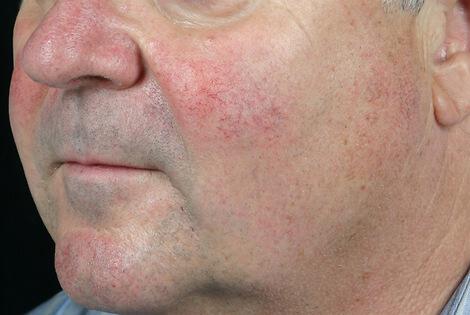 Laser Skin Resurfacing Gallery Before & After Image