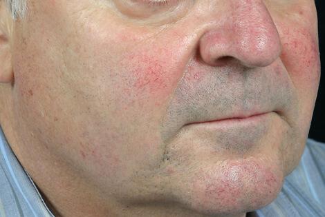 Laser Skin Resurfacing Gallery Before & After Image