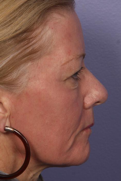 Laser Skin Resurfacing Gallery Before & After Image