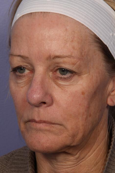 Laser Skin Resurfacing Gallery Before & After Image