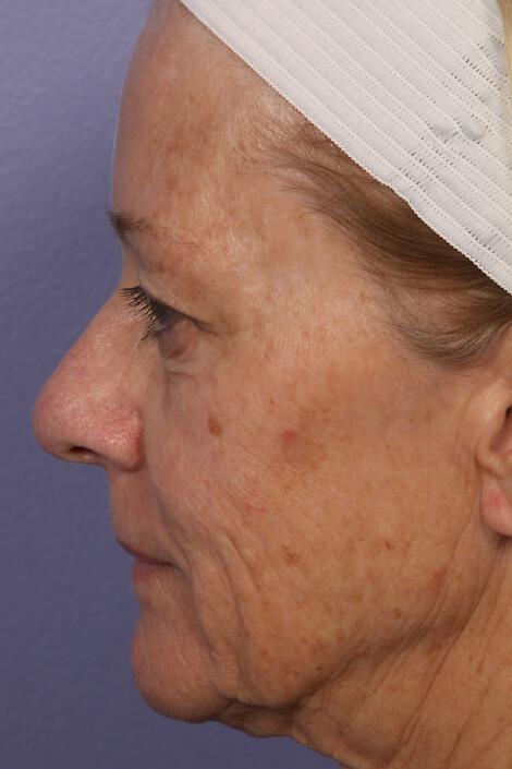 Laser Skin Resurfacing Gallery Before & After Image