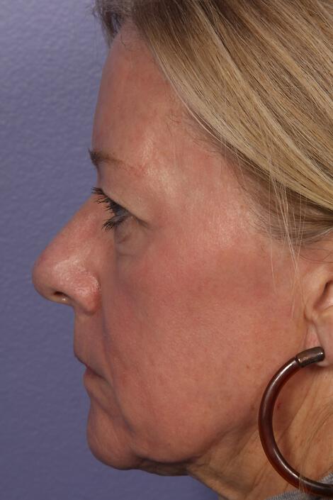 Laser Skin Resurfacing Gallery Before & After Image