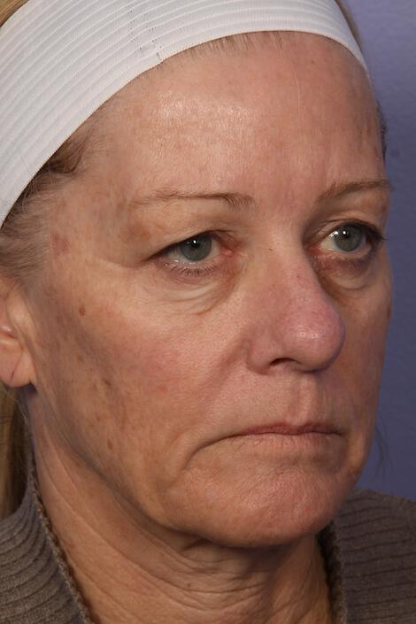 Laser Skin Resurfacing Gallery Before & After Image