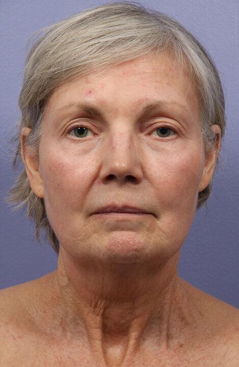 Laser Skin Resurfacing Gallery Before & After Image