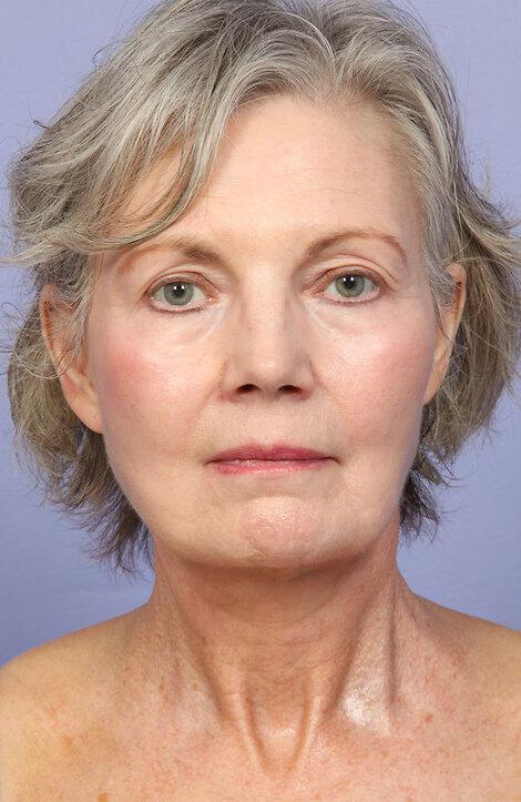 Laser Skin Resurfacing Gallery Before & After Image