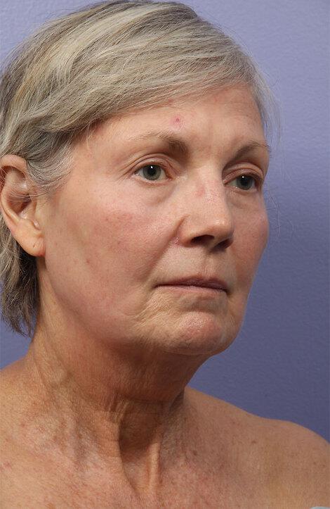 Laser Skin Resurfacing Gallery Before & After Image