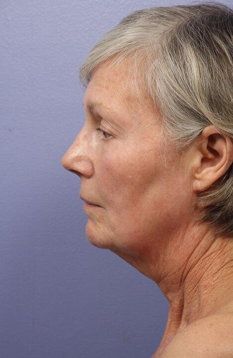 Laser Skin Resurfacing Gallery Before & After Image