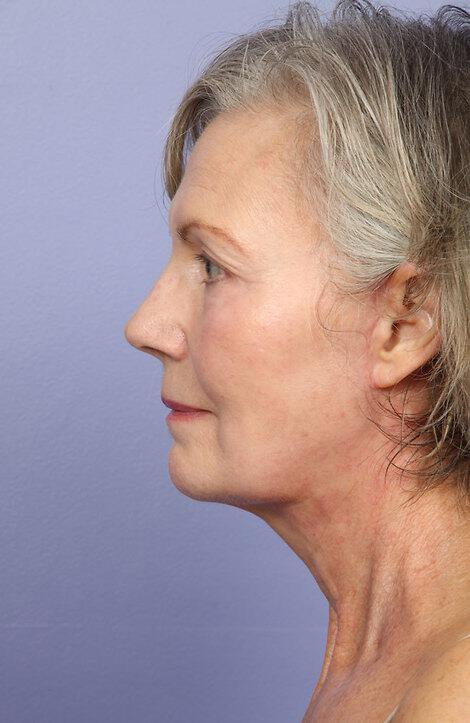 Laser Skin Resurfacing Gallery Before & After Image