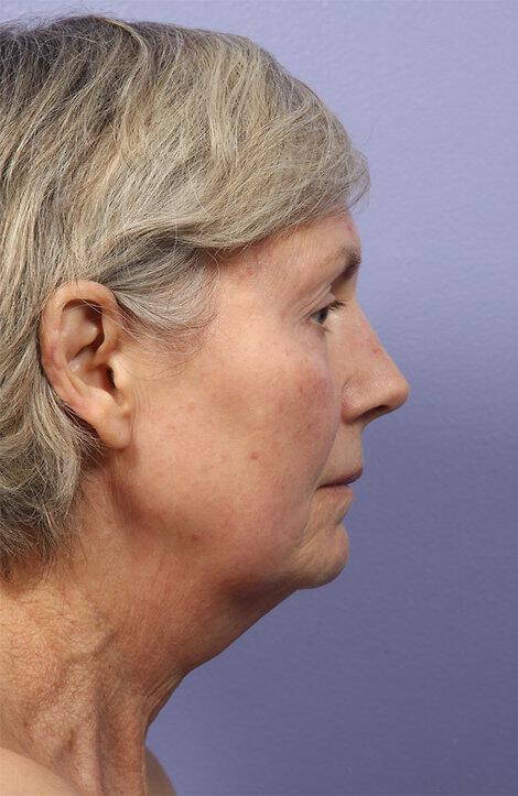 Laser Skin Resurfacing Gallery Before & After Image