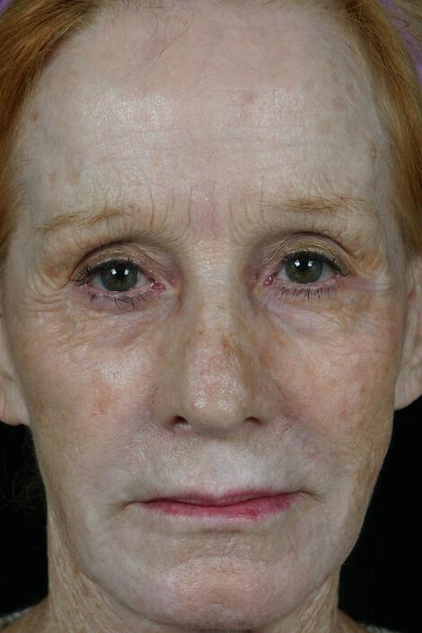 Laser Skin Resurfacing Gallery Before & After Image