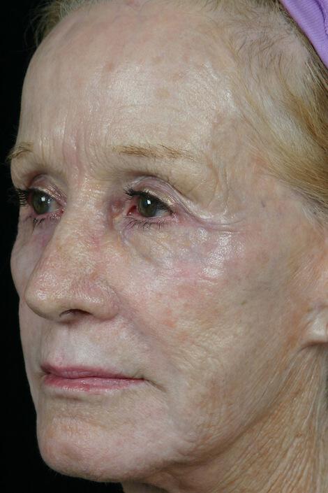 Laser Skin Resurfacing Gallery Before & After Image