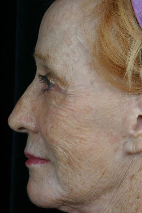 Laser Skin Resurfacing Gallery Before & After Image