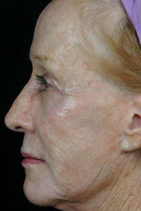 Laser Skin Resurfacing Gallery Before & After Image