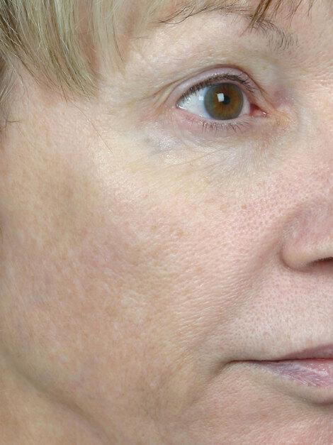 Laser Skin Resurfacing Gallery Before & After Image