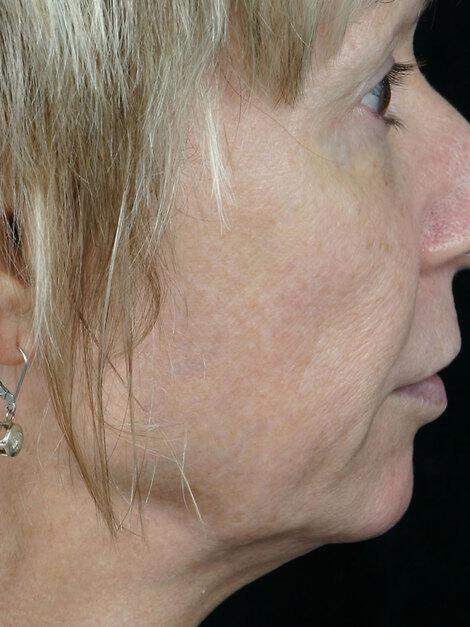 Laser Skin Resurfacing Gallery Before & After Image