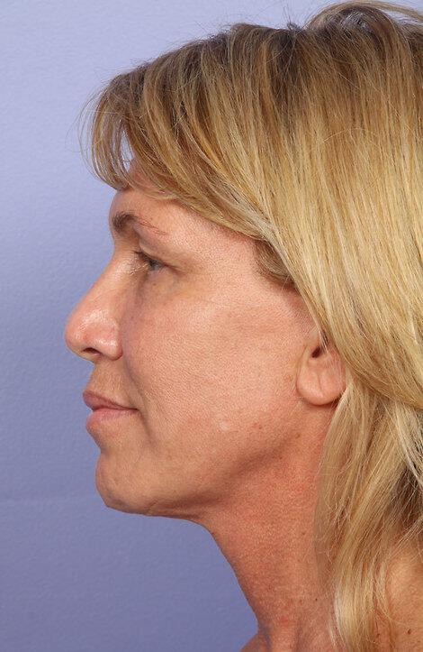 Laser Skin Resurfacing Gallery Before & After Image