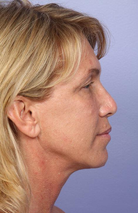 Laser Skin Resurfacing Gallery Before & After Image